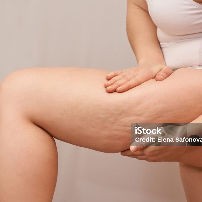 Cellulite leg woman pinch. Test fat hips treatment. Over weight liposuction. Remove striae.
