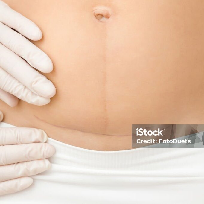 Doctor hands in rubber protective gloves examining woman belly. Caesarean scar after surgery because of baby birth. Closeup. Front view.