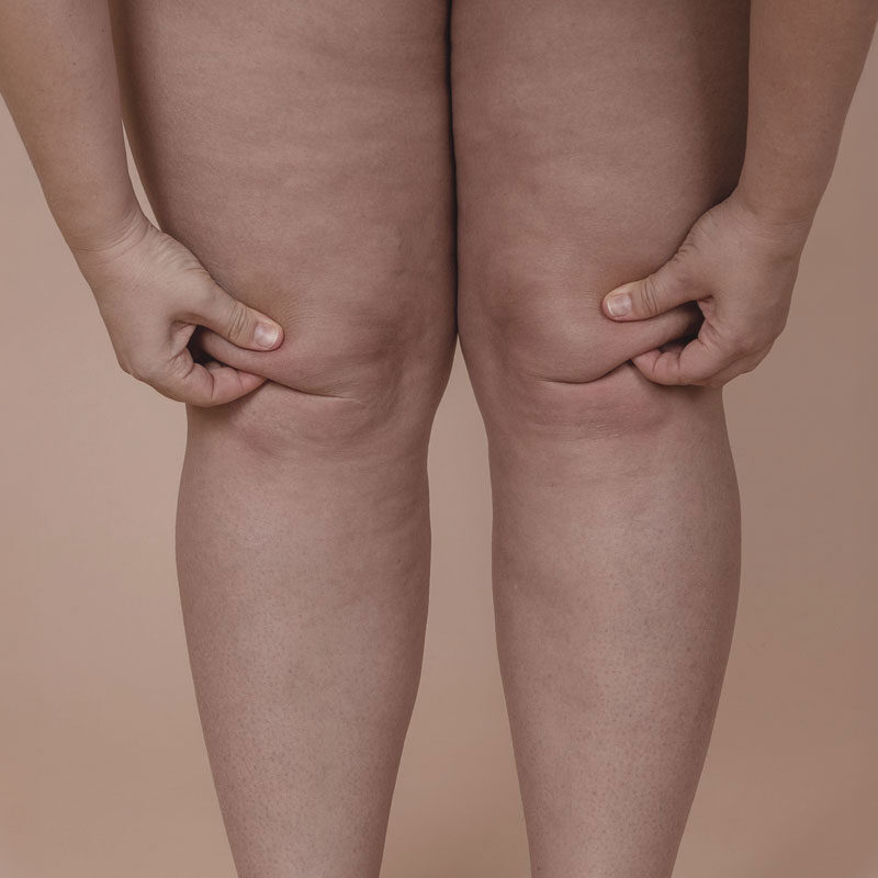 lipedema_up